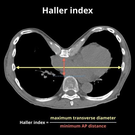 haller index
